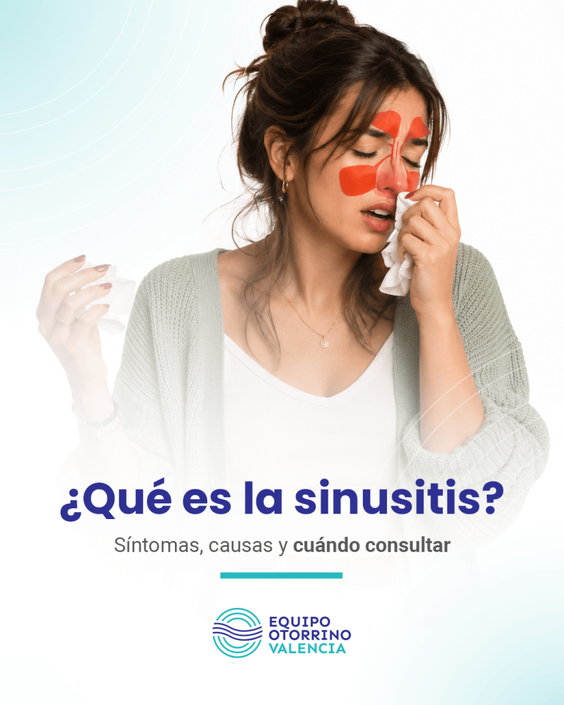 ¿Qué es la sinusitis? Síntomas, causas y cuándo consultar